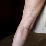 Leia mais sobre o artigo Tem medo de tratar as varizes por causa da cirurgia?