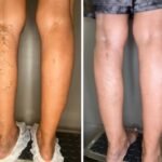 Leia mais sobre o artigo O que é cirurgia de laser endovenoso?