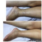 Leia mais sobre o artigo Como fica a perna depois de aplicação de espuma?