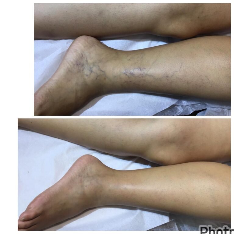 Leia mais sobre o artigo Como fica a perna depois de aplicação de espuma?