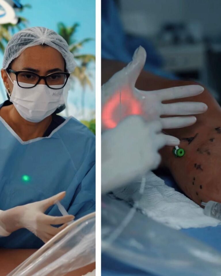 Leia mais sobre o artigo Laser Endovenoso para Veia Safena: tratamento moderno sem cortes