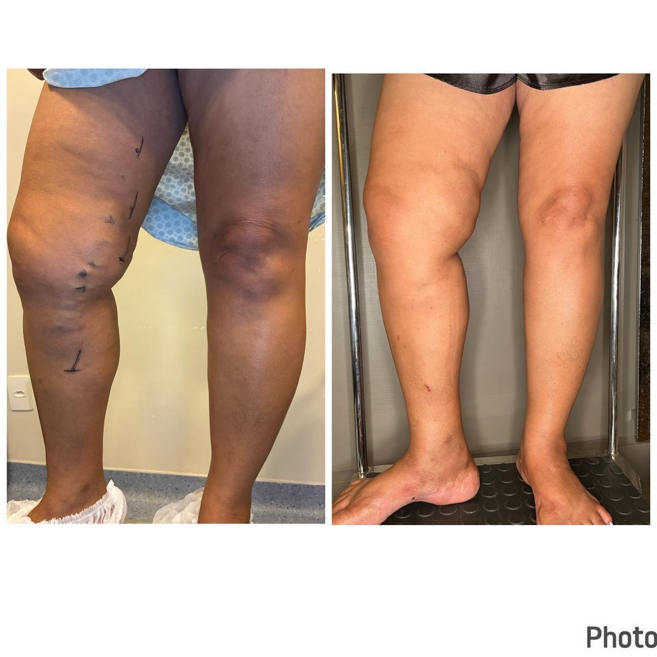 Consulta vascular sobre tratamento de varizes e indicação de cirurgia.