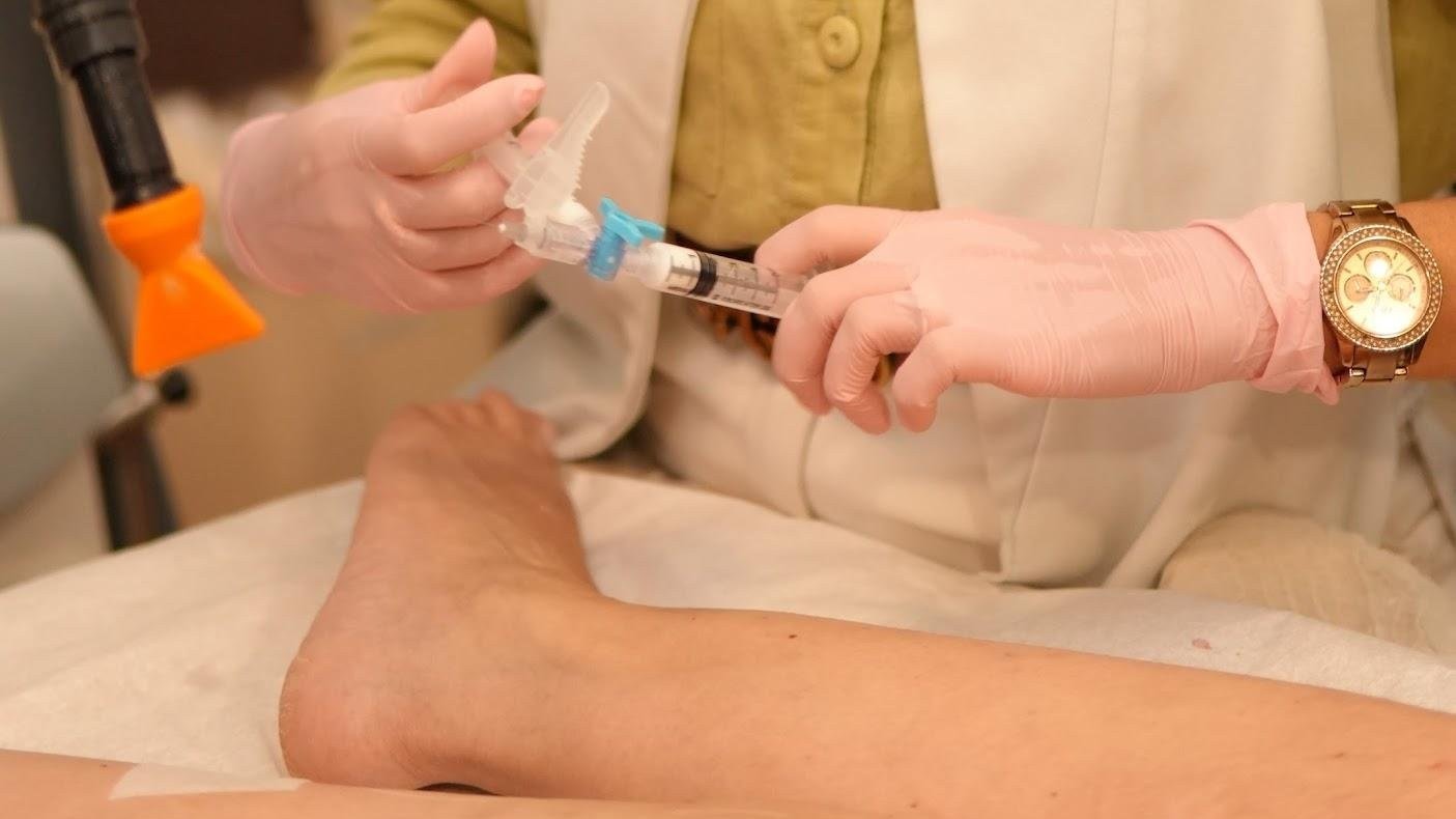 Médica aplica escleroterapia com seringa na perna da paciente, com aplicador de laser ao lado